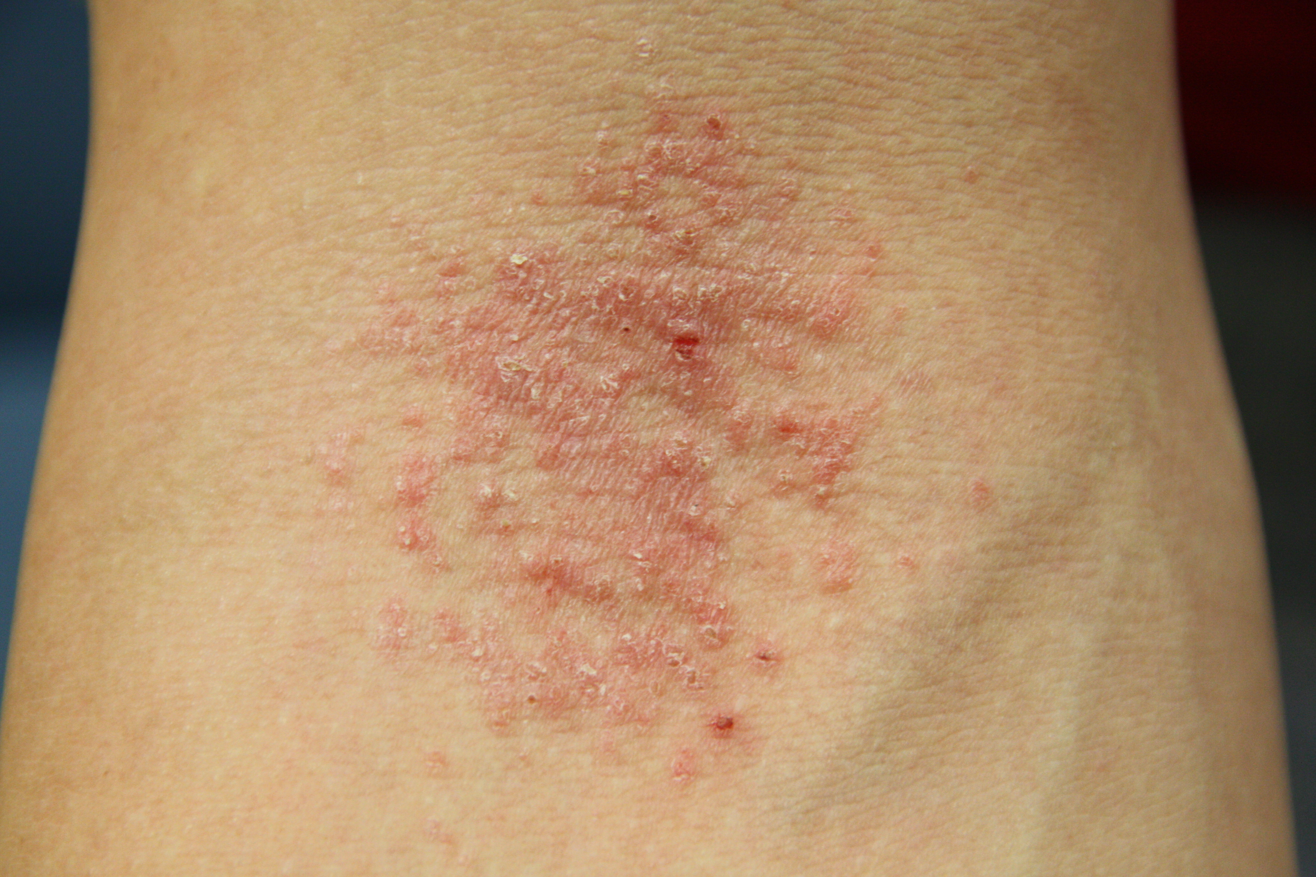 Eczema Picture Image on MedicineNet.com